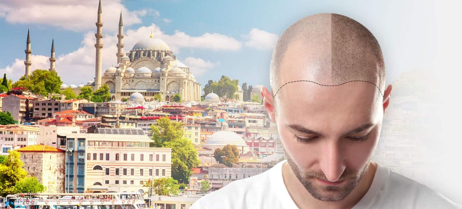 Hair Transplant Tourism: Why Turkey Remains the Top Destination